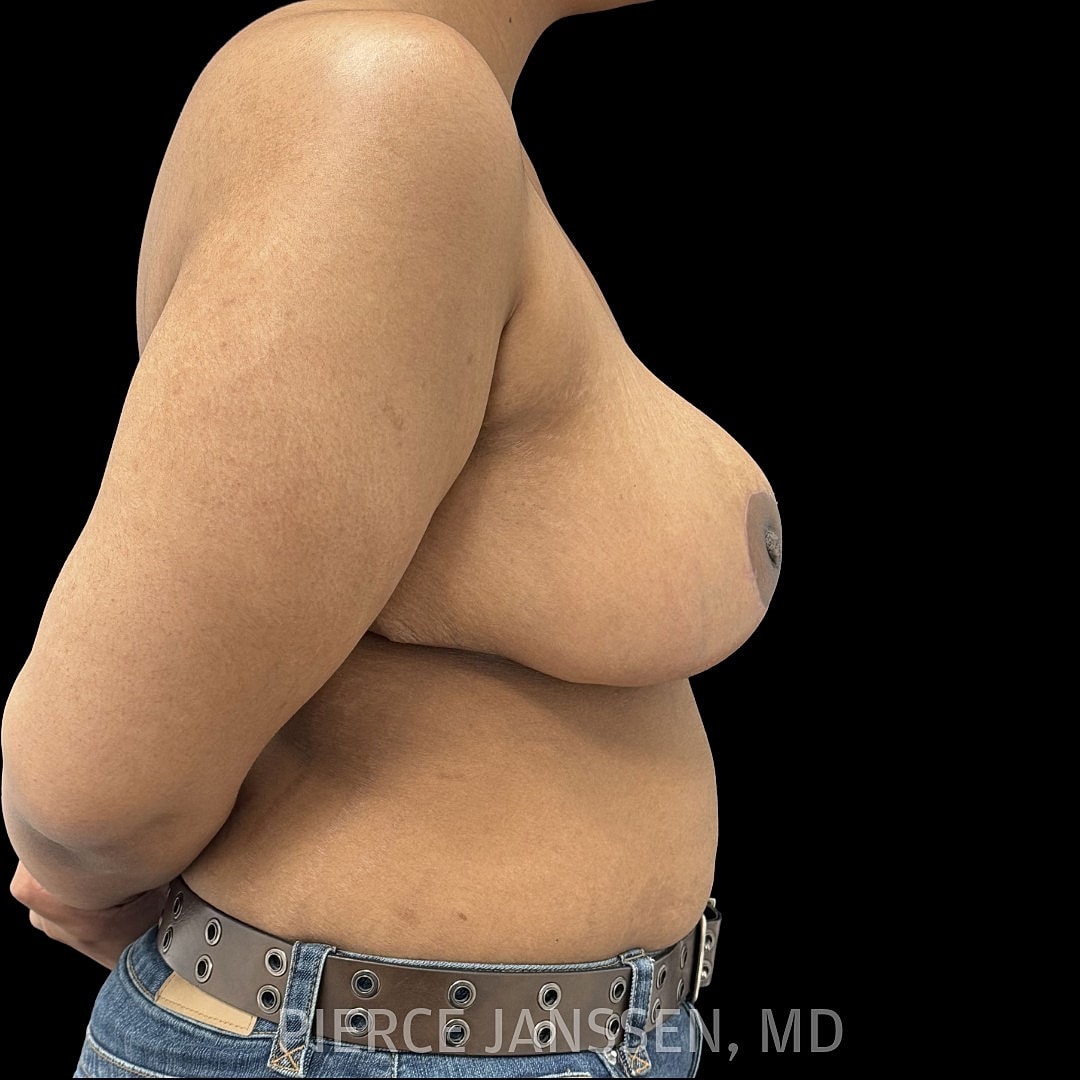 Breast Reduction Before & After