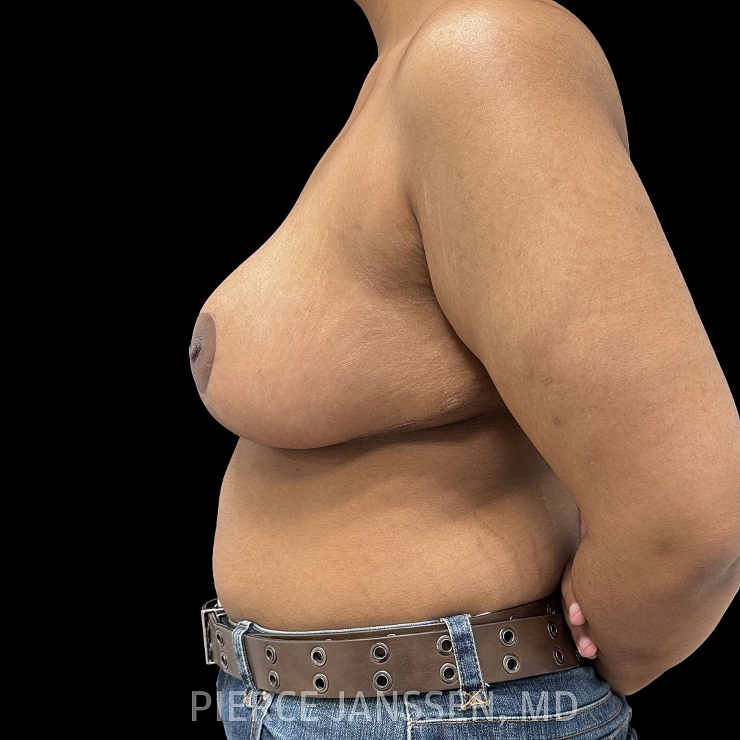 Breast Reduction Before & After