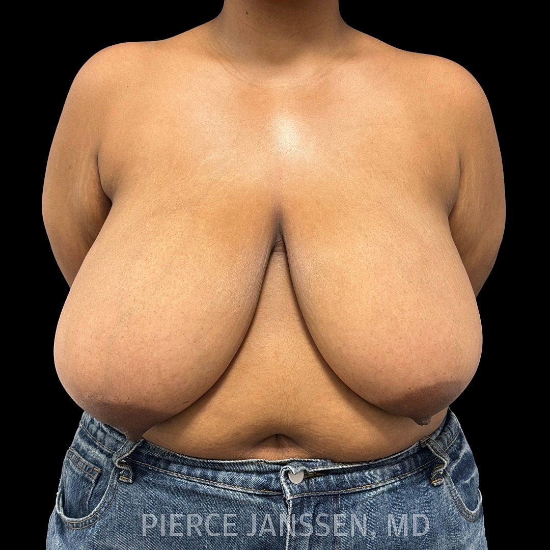 Breast Reduction Before & After