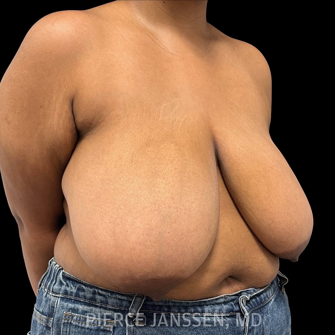 Breast Reduction Before & After
