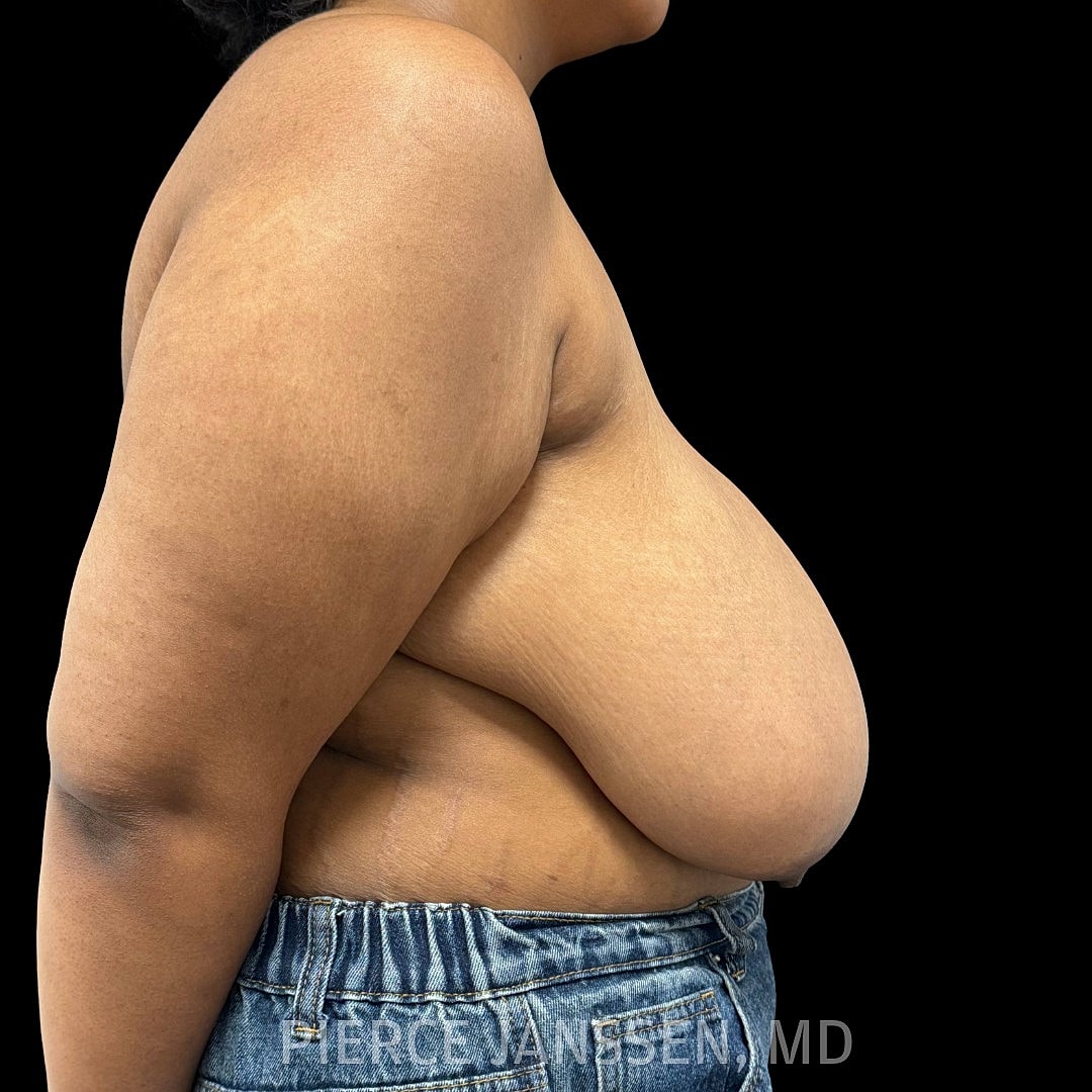 Breast Reduction Before & After