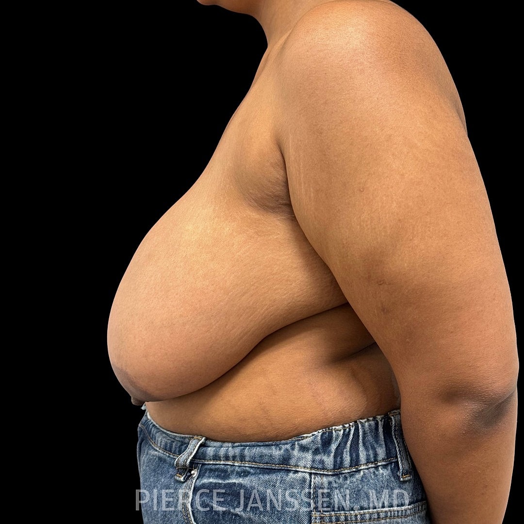 Breast Reduction Before & After