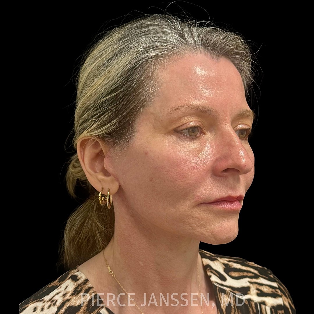 Deep Plane Facelift Before & After