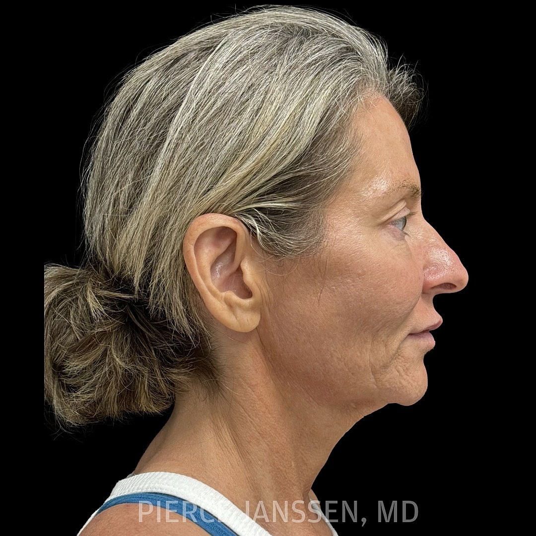 Deep Plane Facelift Before & After
