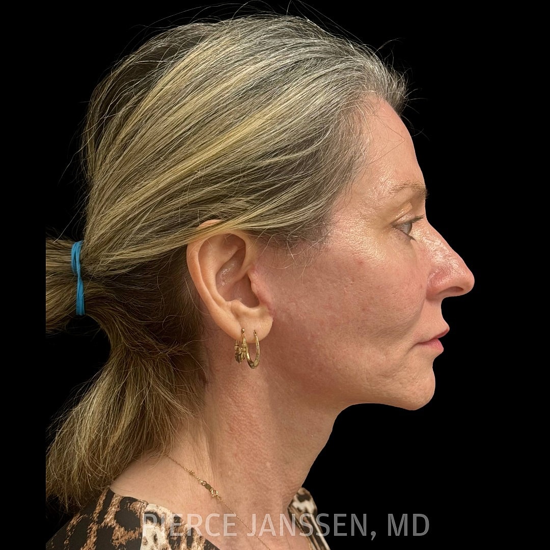 Deep Plane Facelift Before & After