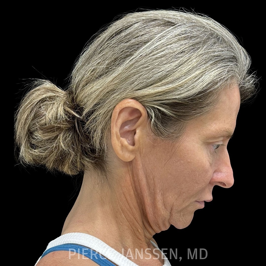 Deep Plane Facelift Before & After