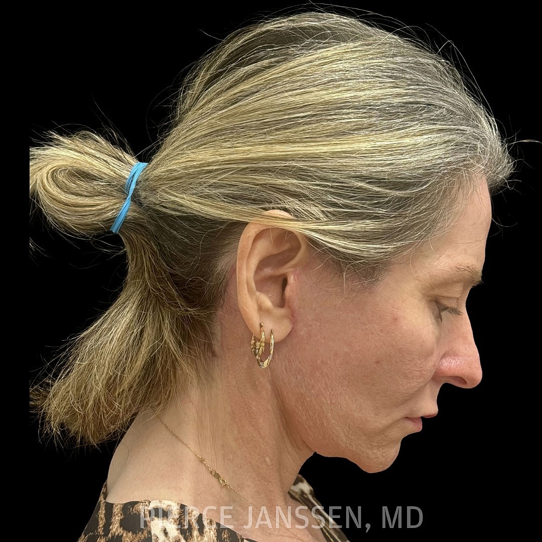 Deep Plane Facelift Before & After