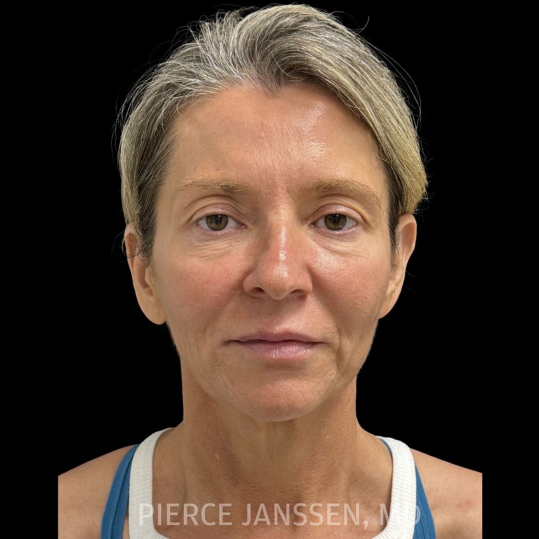 Deep Plane Facelift Before & After