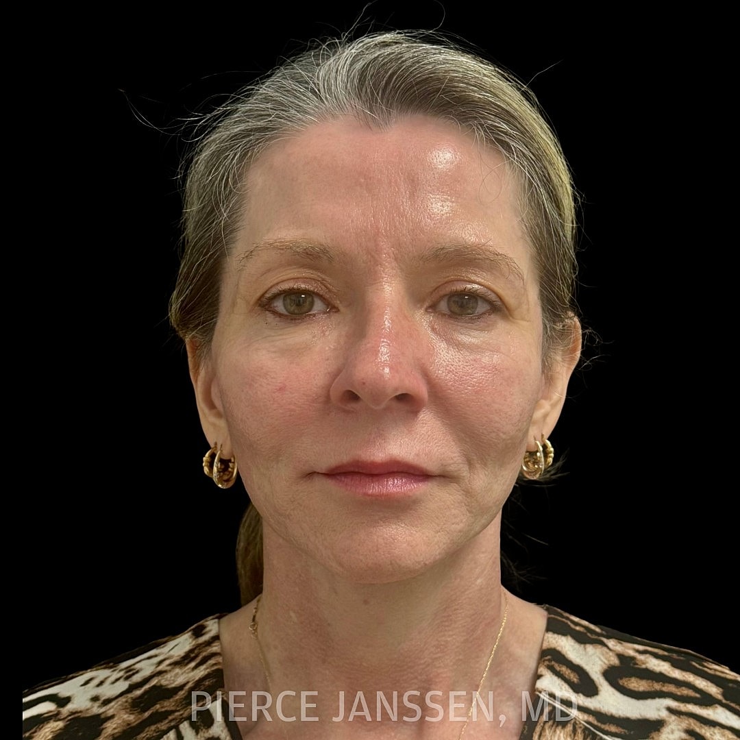 Deep Plane Facelift Before & After