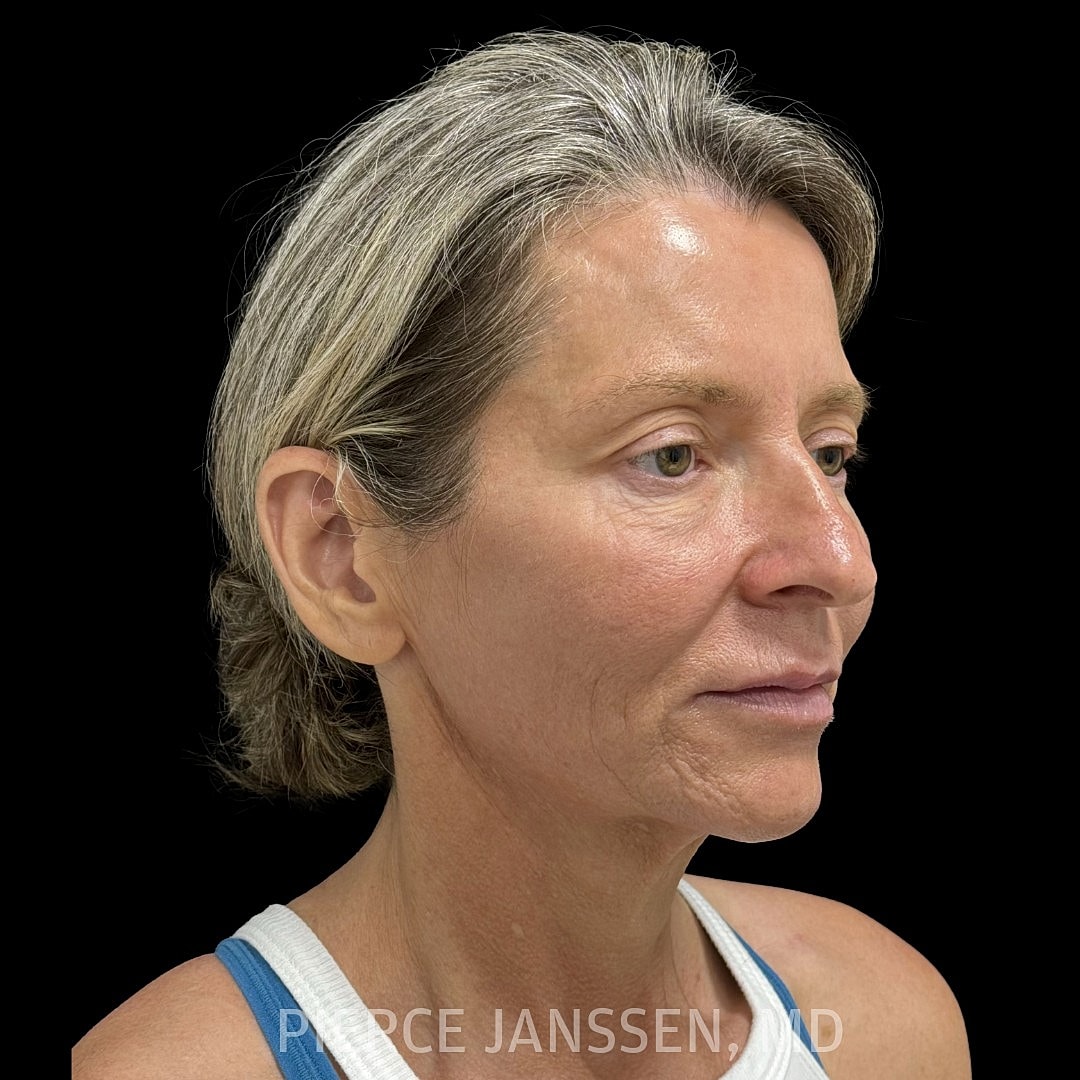 Deep Plane Facelift Before & After