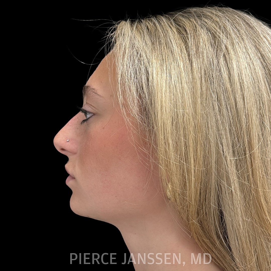 Rhinoplasty Before & After
