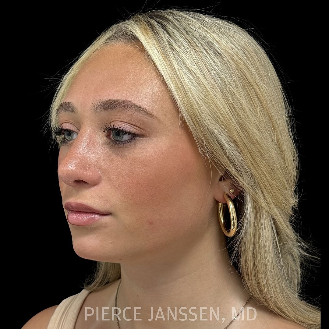 Rhinoplasty Before & After