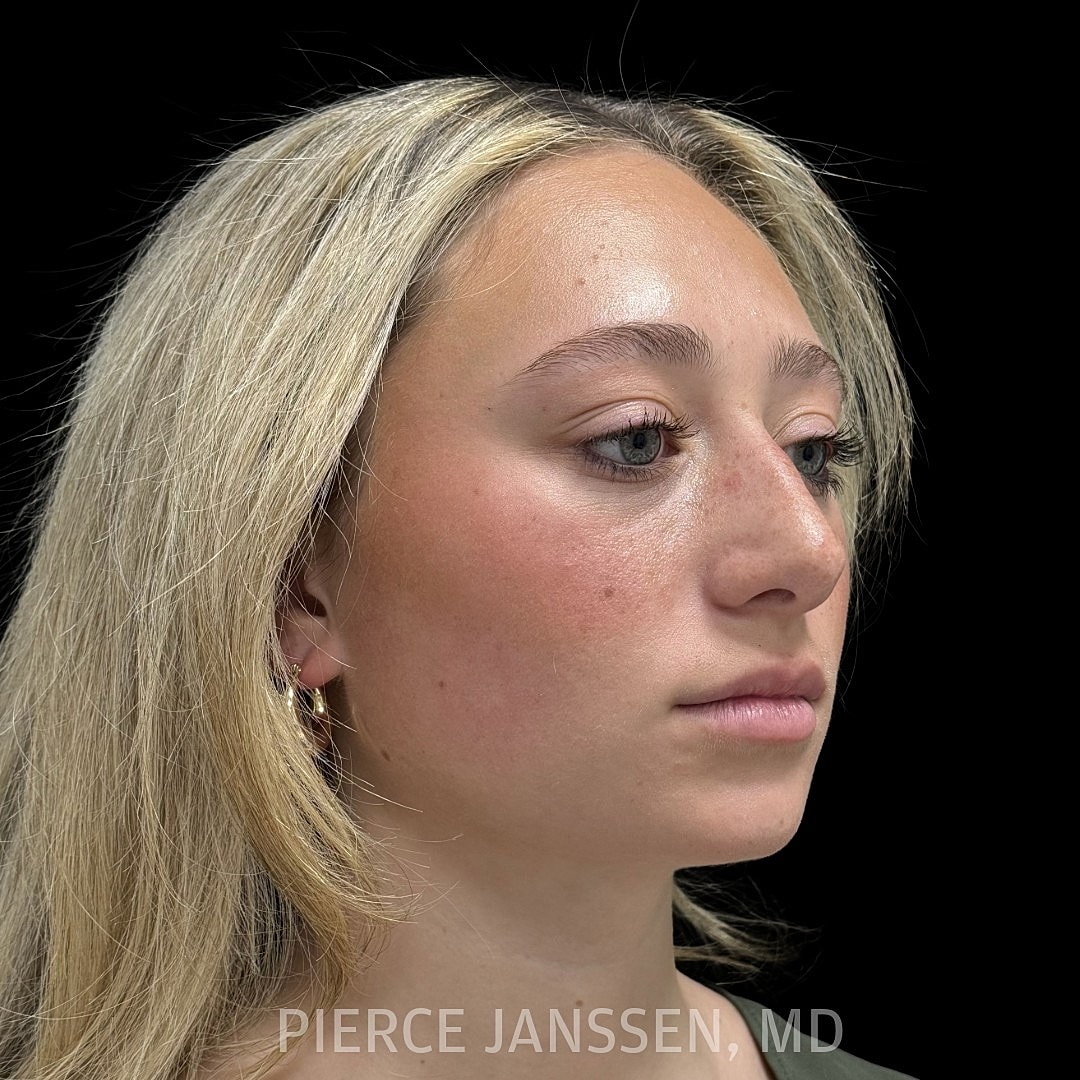 Rhinoplasty Before & After