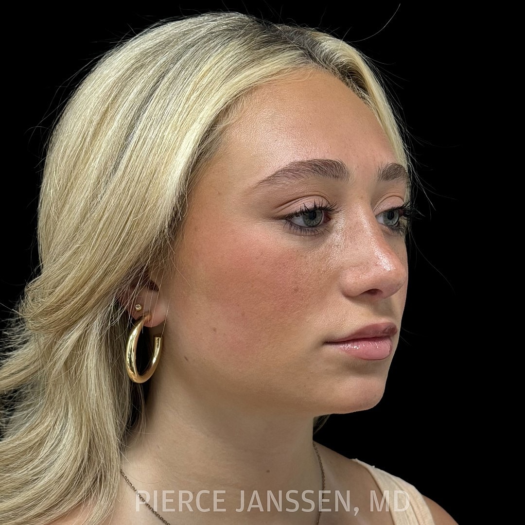 Rhinoplasty Before & After