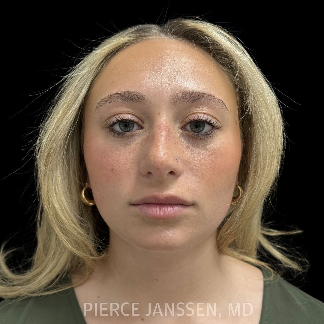 Rhinoplasty Before & After