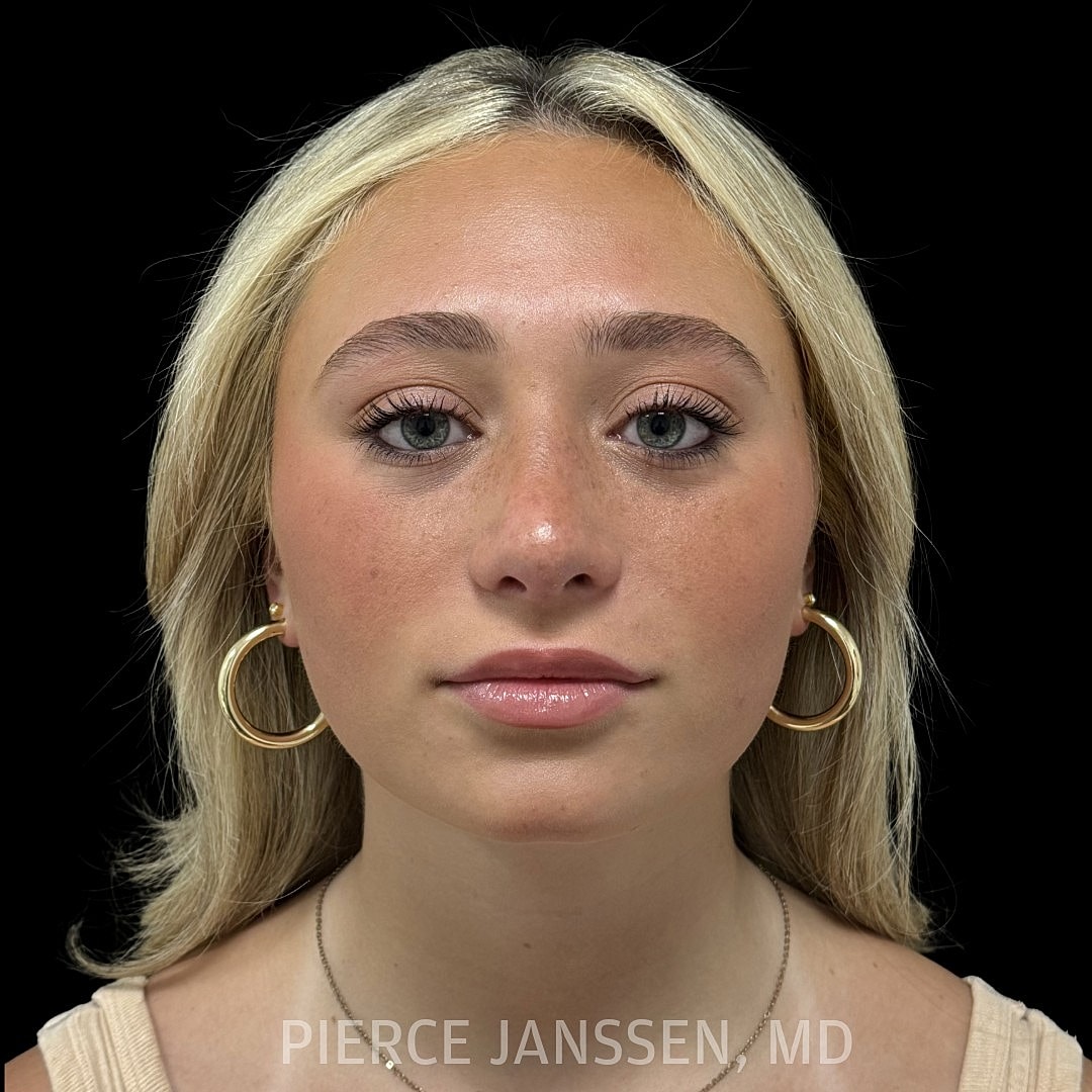 Rhinoplasty Before & After