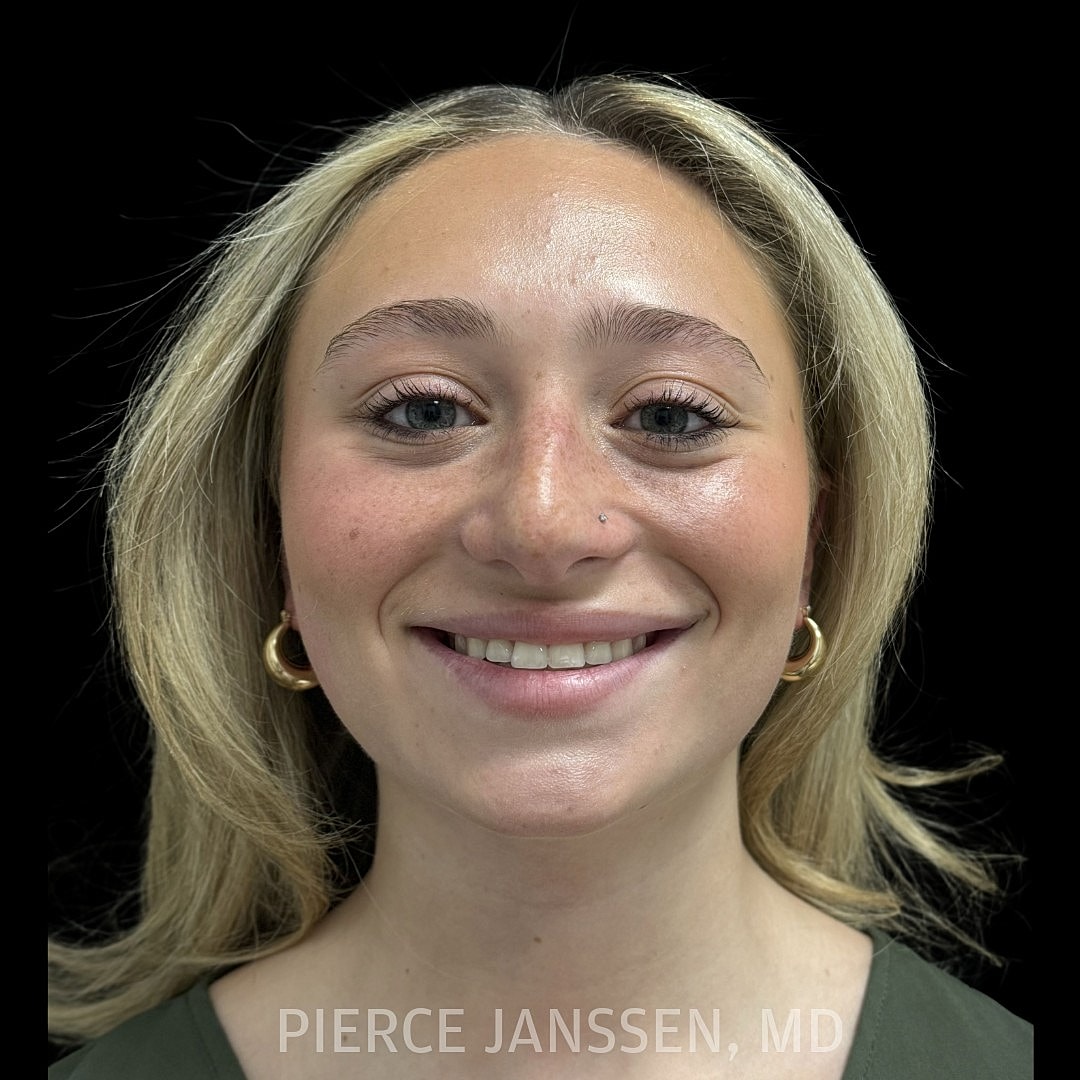 Rhinoplasty Before & After