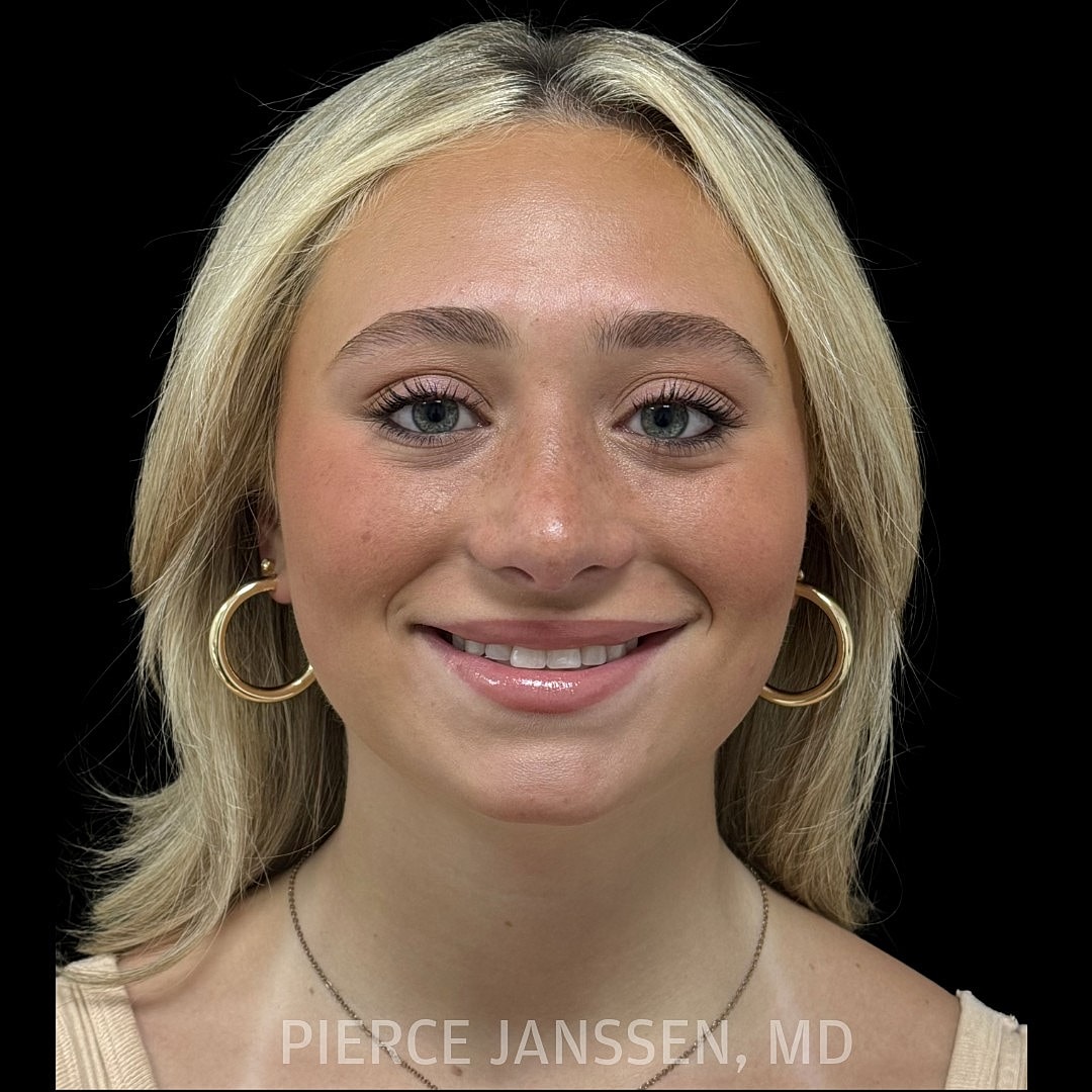 Rhinoplasty Before & After