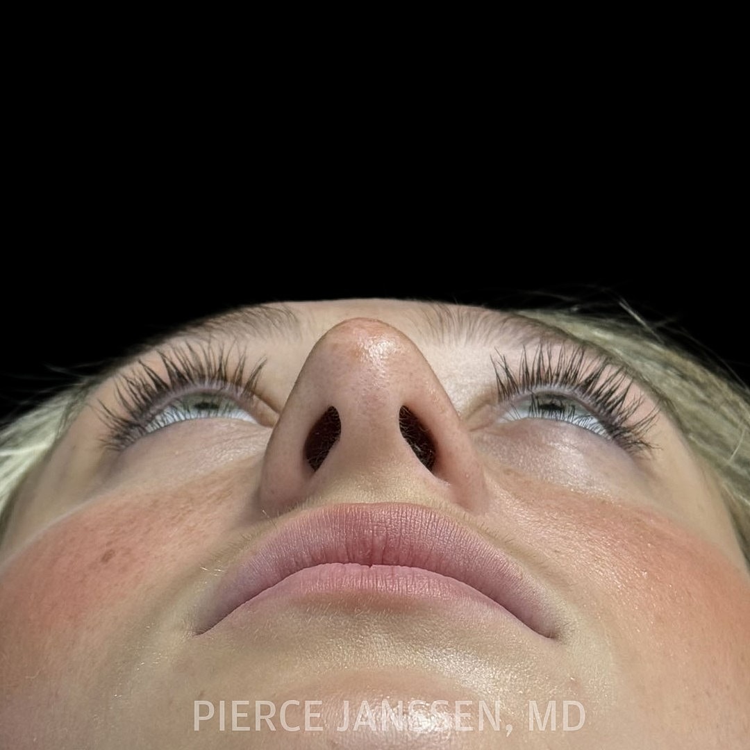 Rhinoplasty Before & After