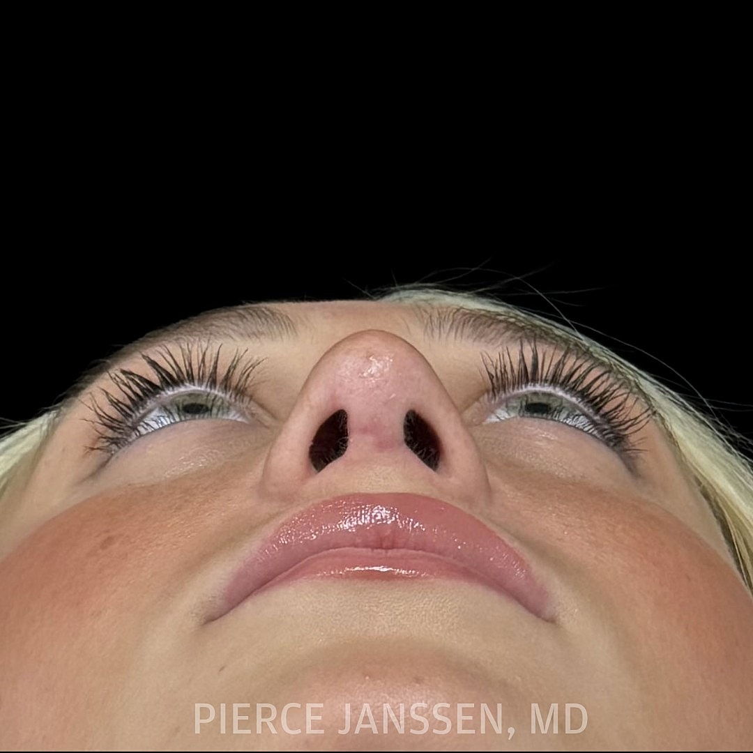 Rhinoplasty Before & After