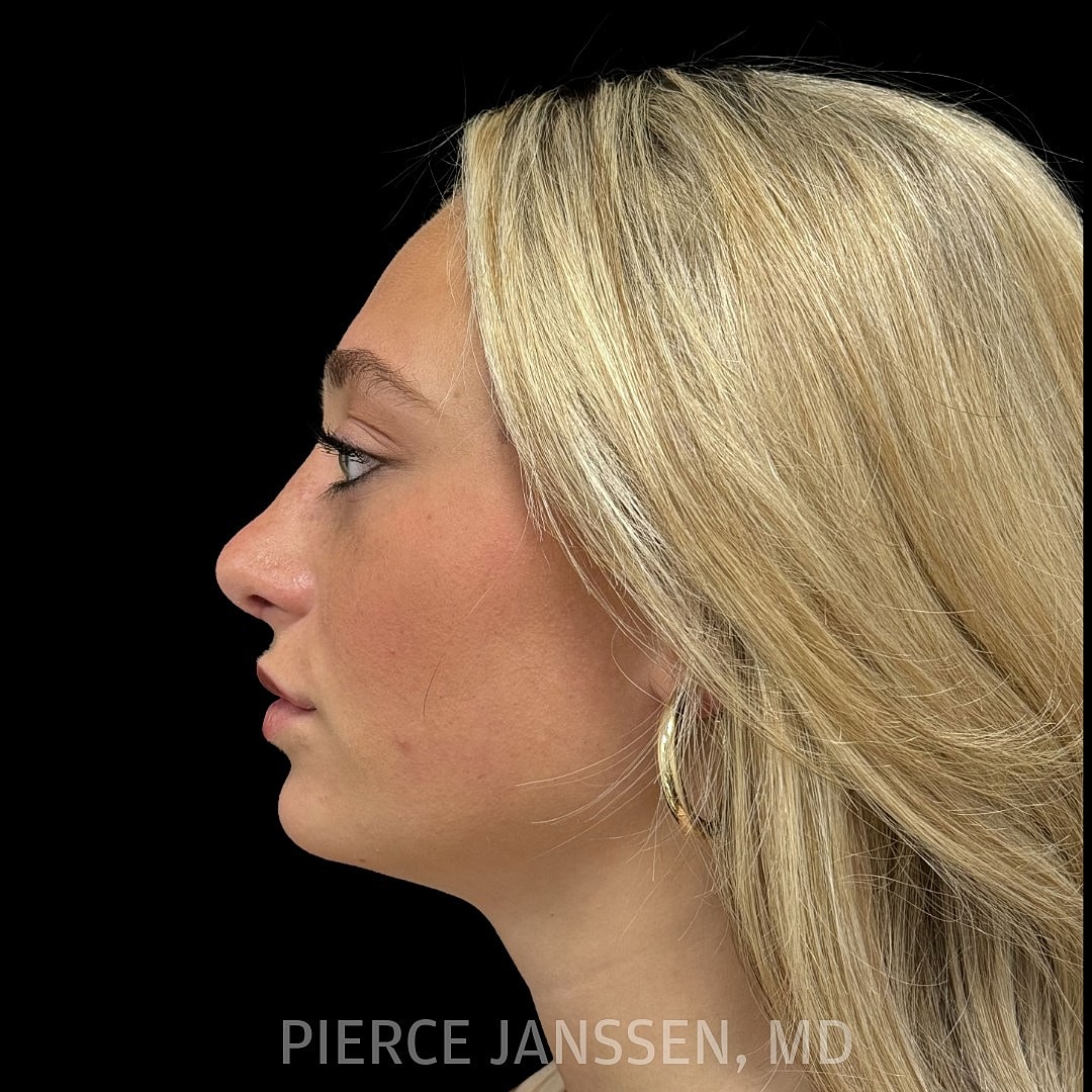 Rhinoplasty Before & After