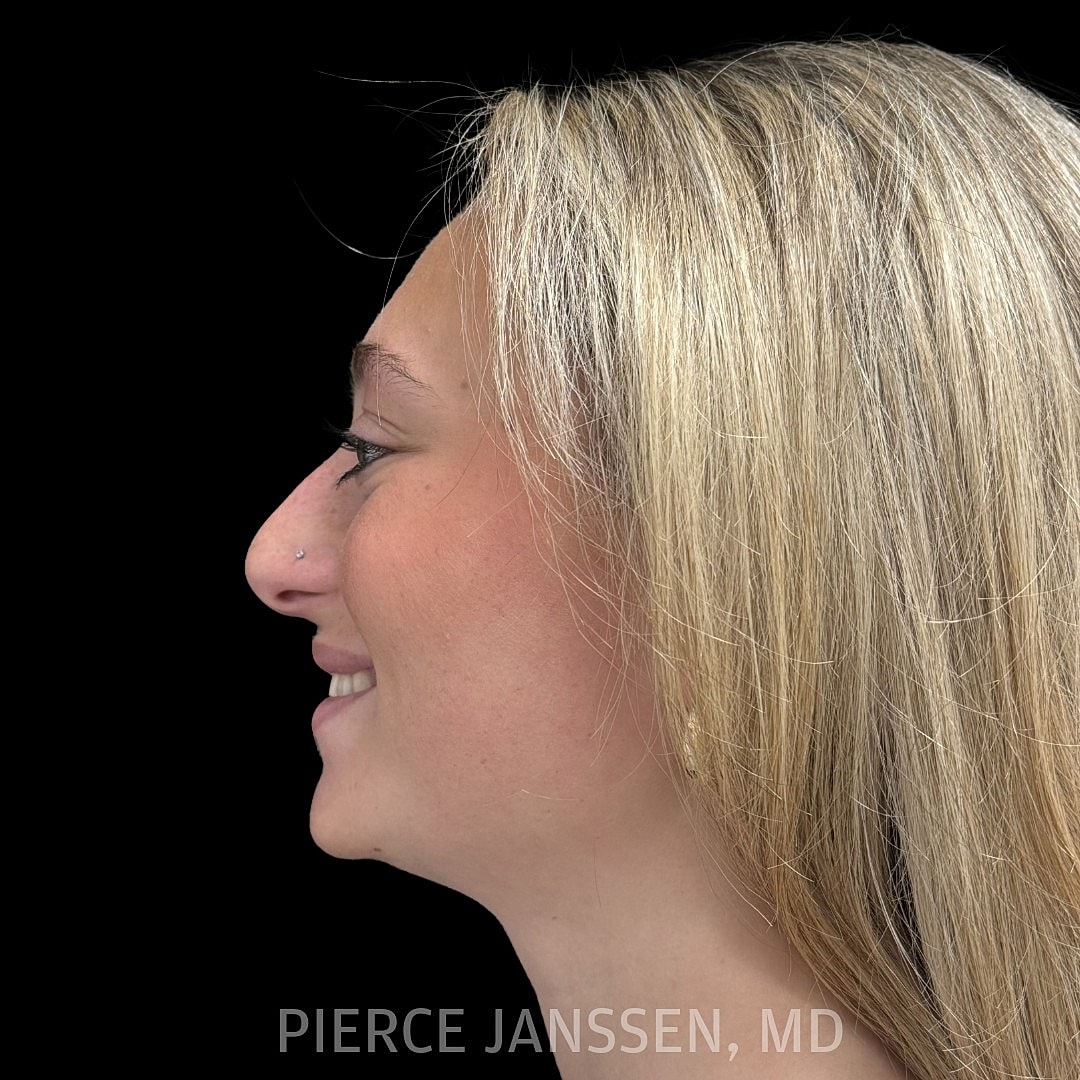 Rhinoplasty Before & After
