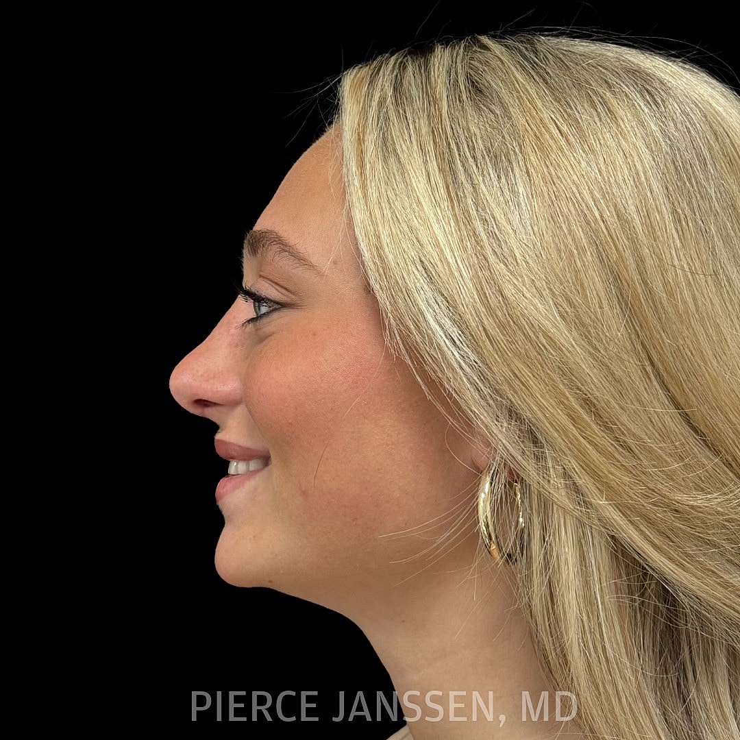 Rhinoplasty Before & After