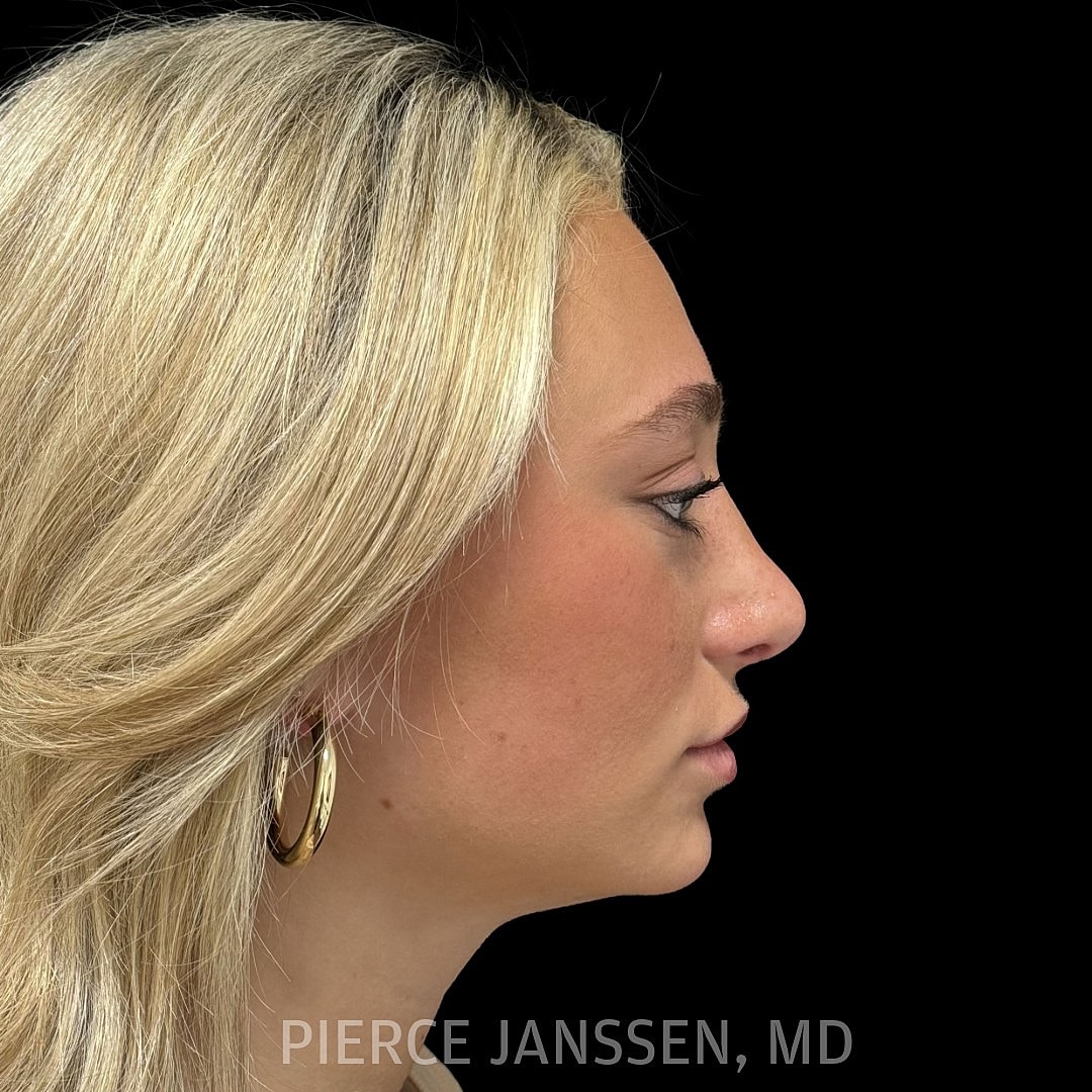Rhinoplasty Before & After