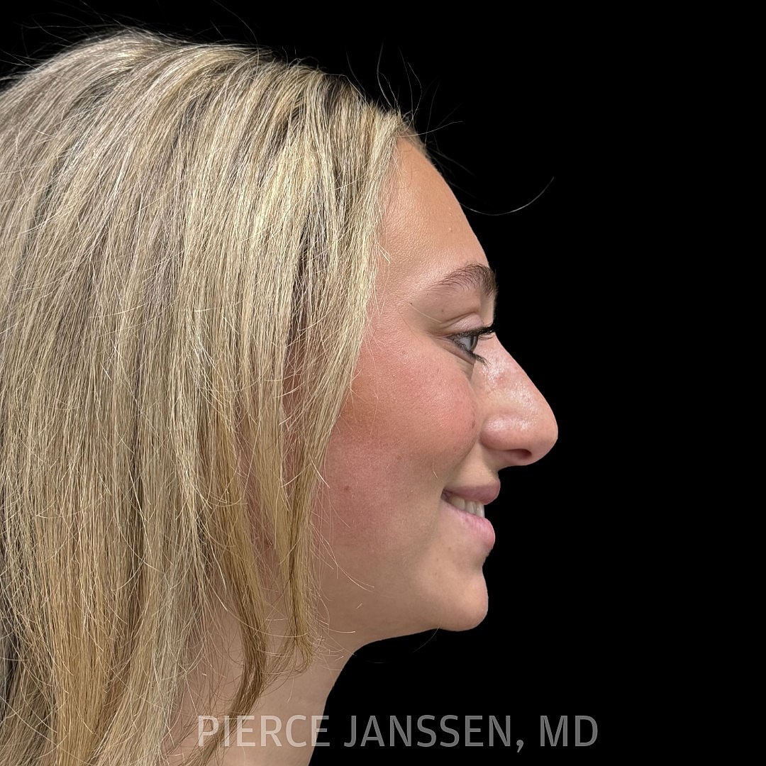 Rhinoplasty Before & After