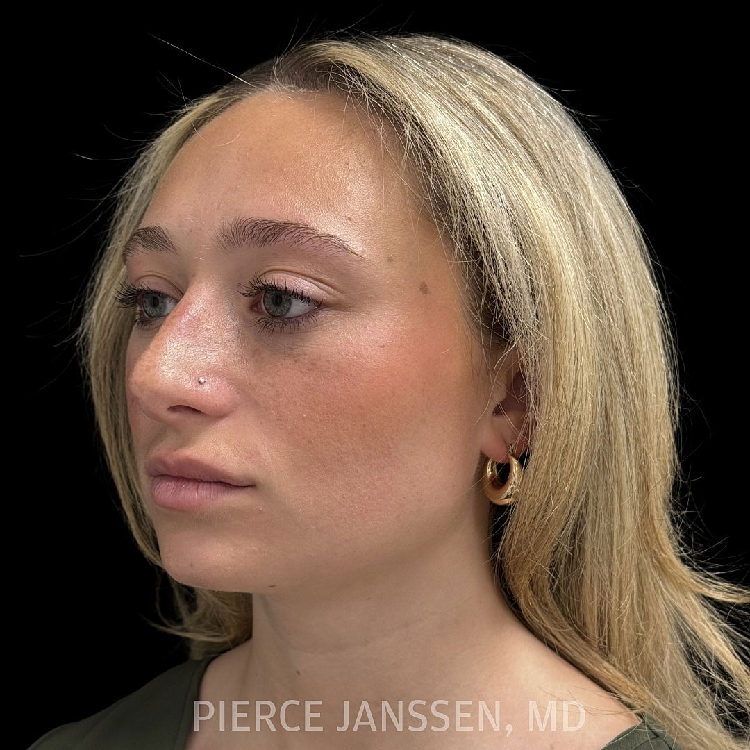 Rhinoplasty Before & After