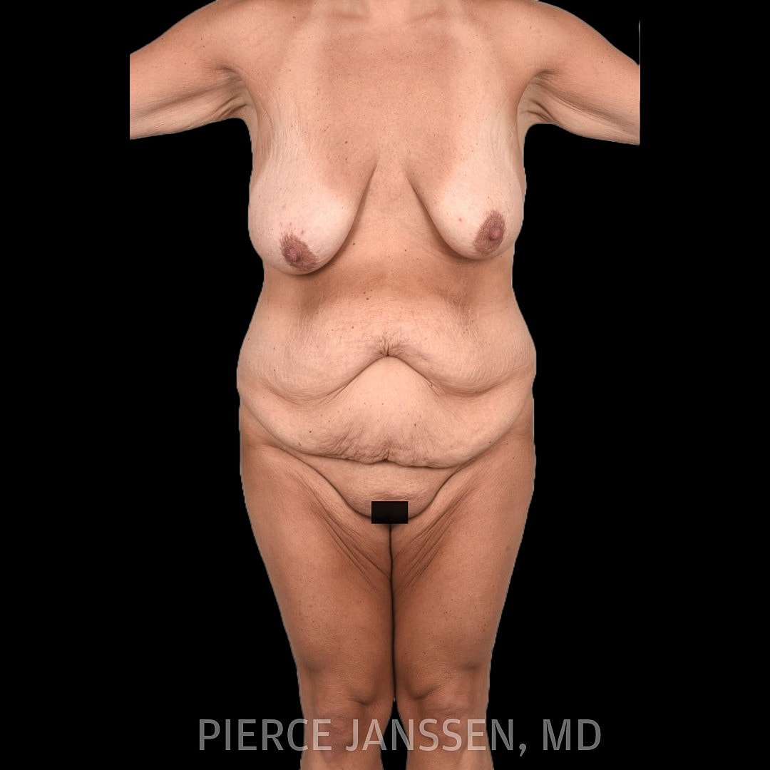 Abdominoplasty (Tummy Tuck) Before & After