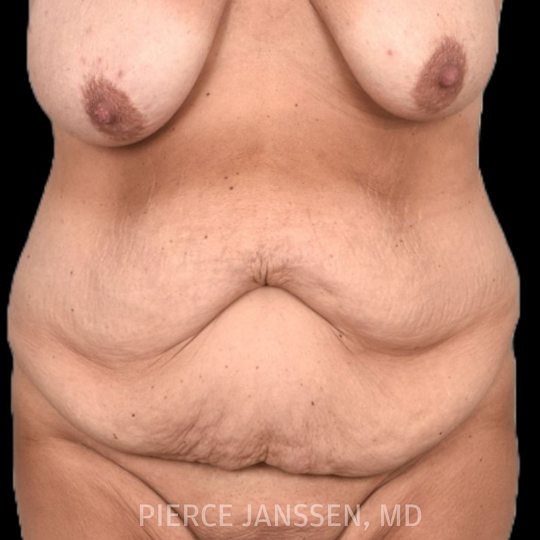 Abdominoplasty (Tummy Tuck) Before & After