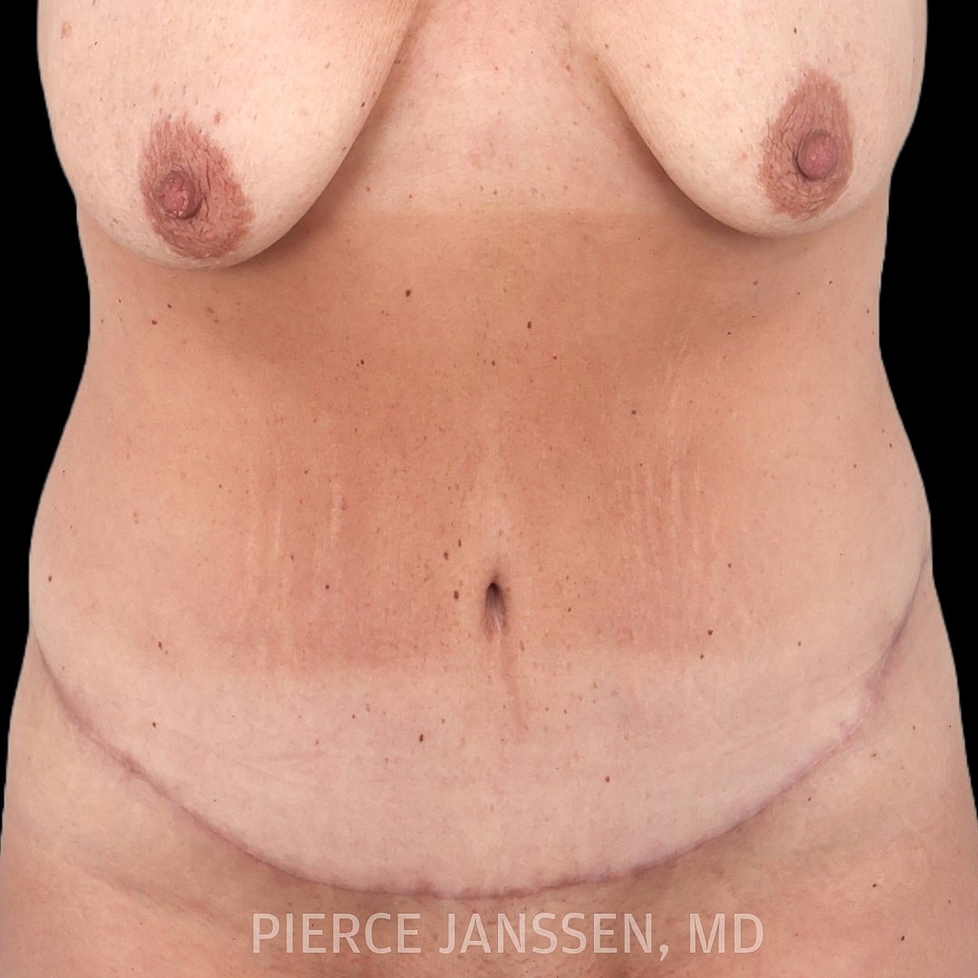 Abdominoplasty (Tummy Tuck) Before & After