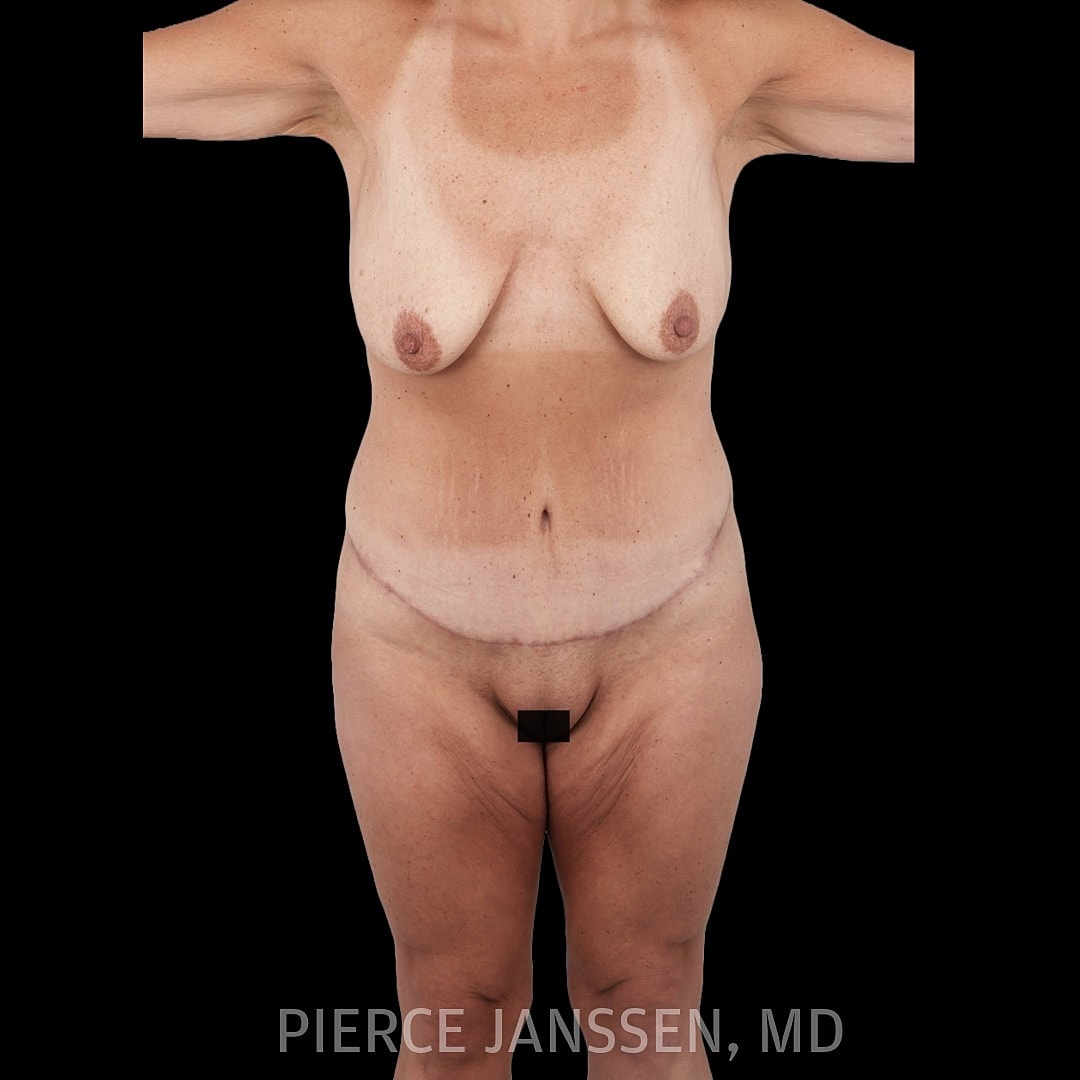 Abdominoplasty (Tummy Tuck) Before & After