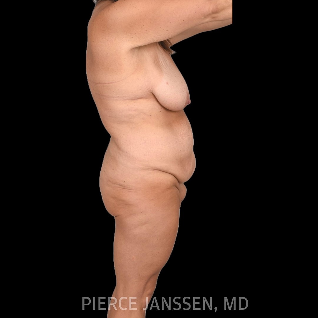 Abdominoplasty (Tummy Tuck) Before & After
