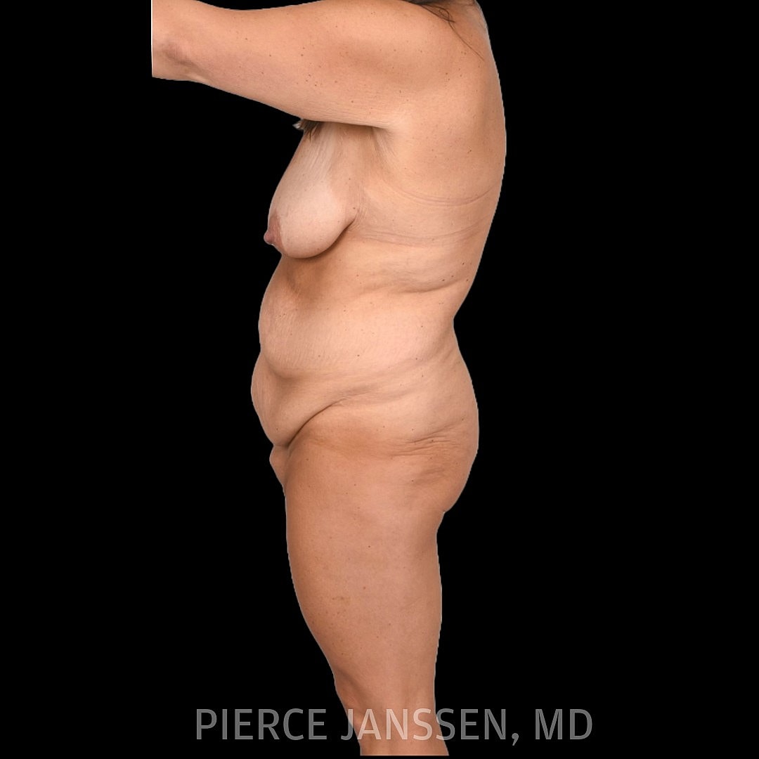 Abdominoplasty (Tummy Tuck) Before & After