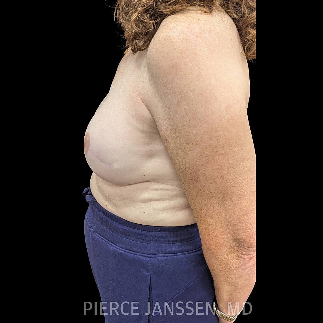 Breast Reconstruction (Implant-Based) Before & After