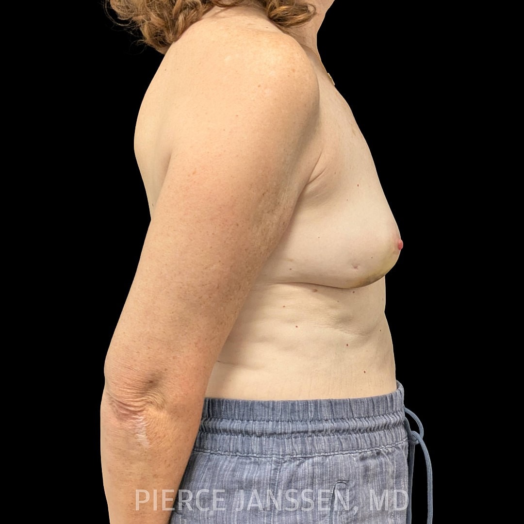 Breast Reconstruction (Implant-Based) Before & After