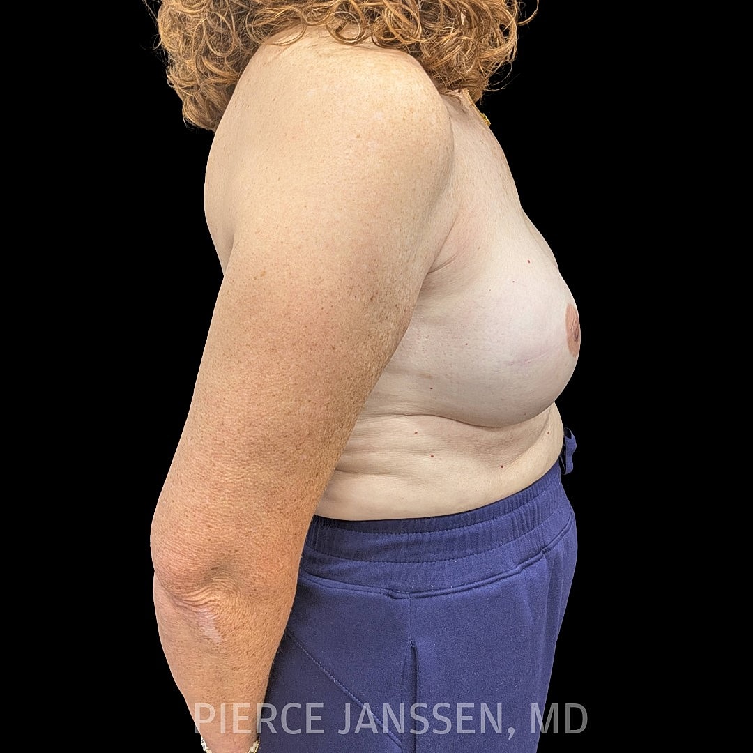 Breast Reconstruction (Implant-Based) Before & After
