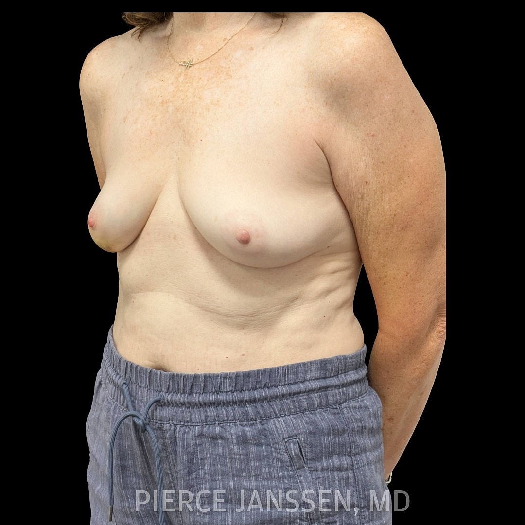 Breast Reconstruction (Implant-Based) Before & After
