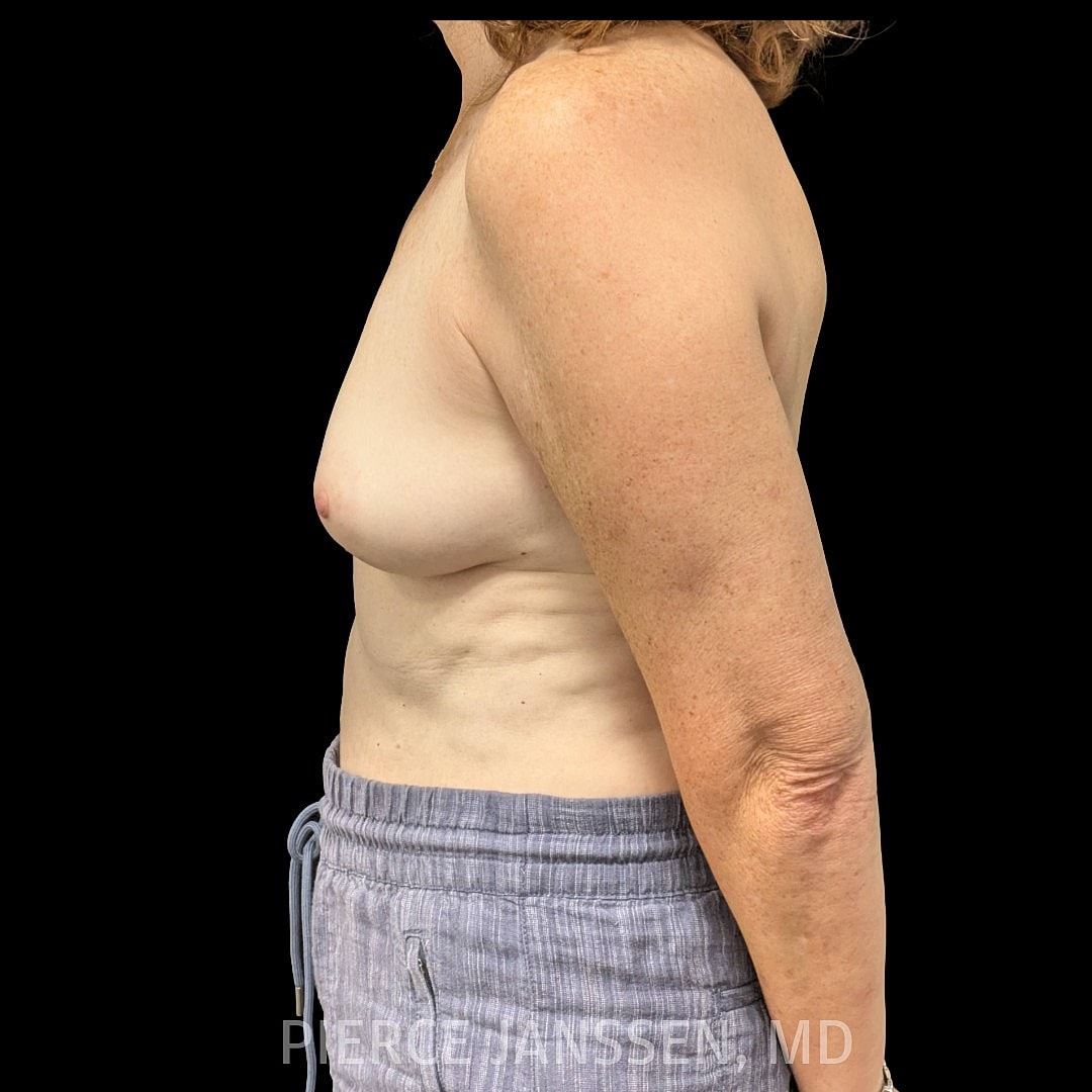 Breast Reconstruction (Implant-Based) Before & After