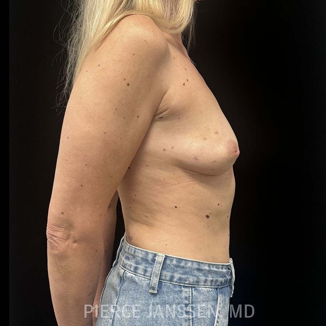 Breast Reconstruction (Implant-Based) Before & After