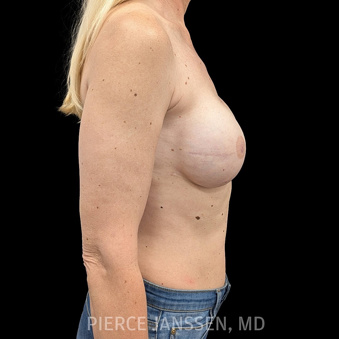Breast Reconstruction (Implant-Based) Before & After