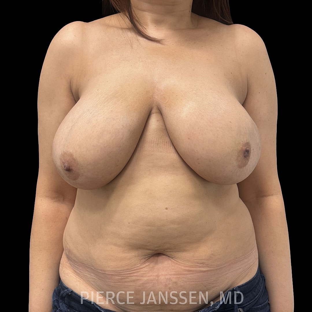 Breast Reconstruction (Implant-Based) Before & After