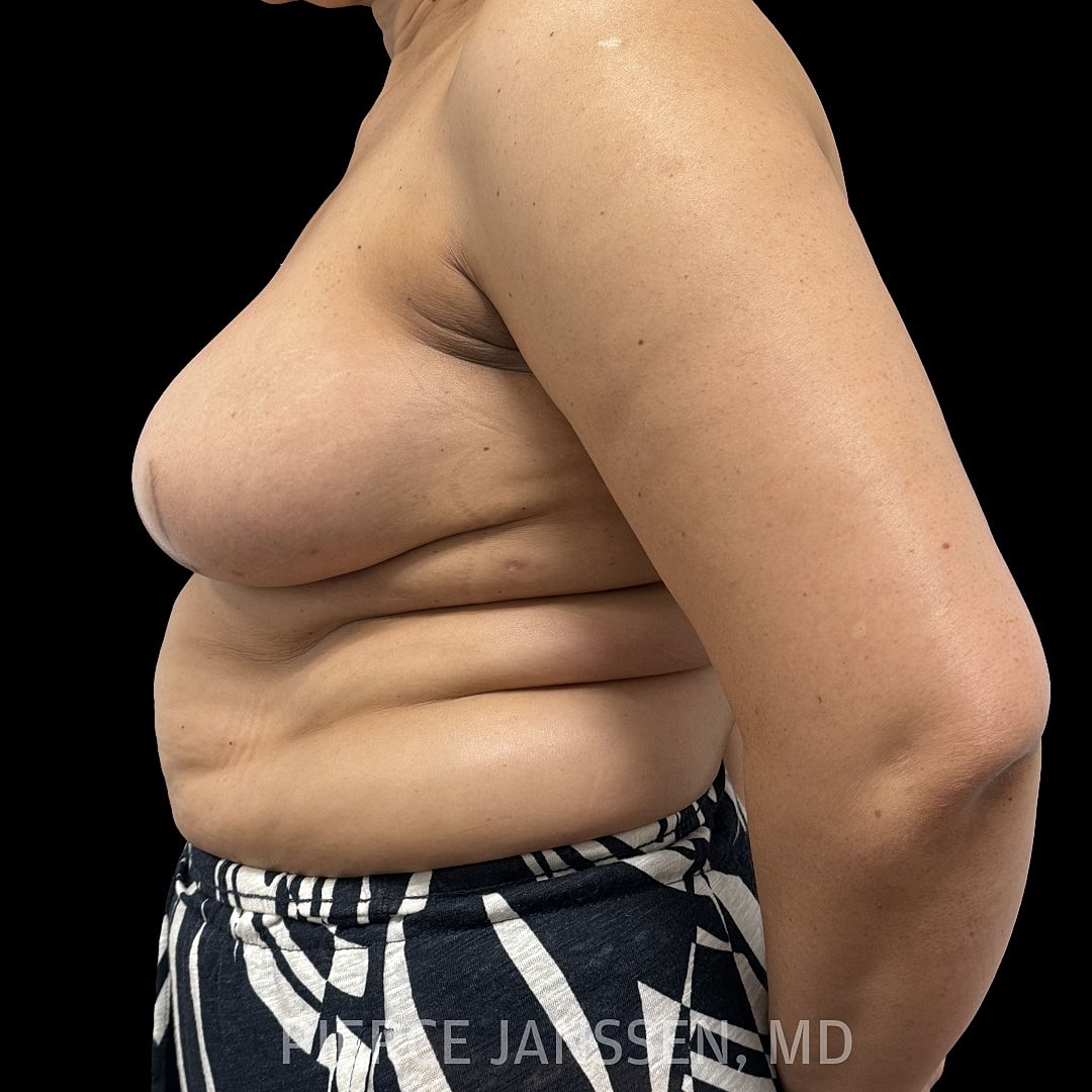 Breast Reconstruction (Implant-Based) Before & After