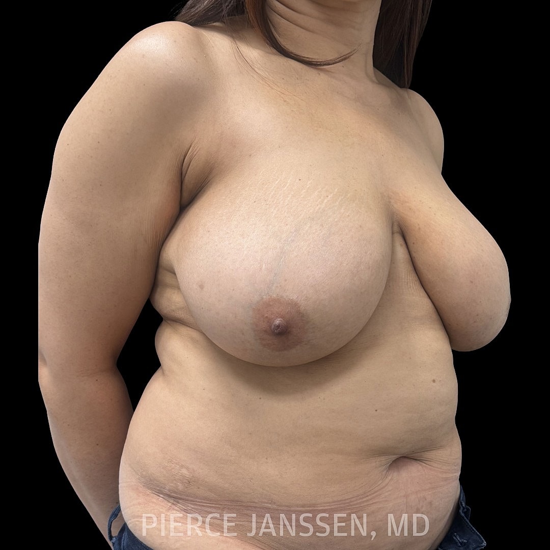 Breast Reconstruction (Implant-Based) Before & After