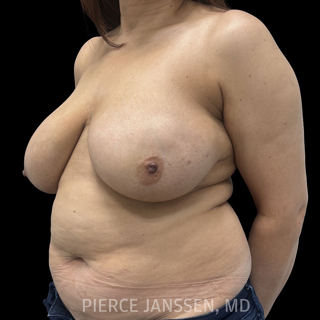 Breast Reconstruction (Implant-Based) Before & After