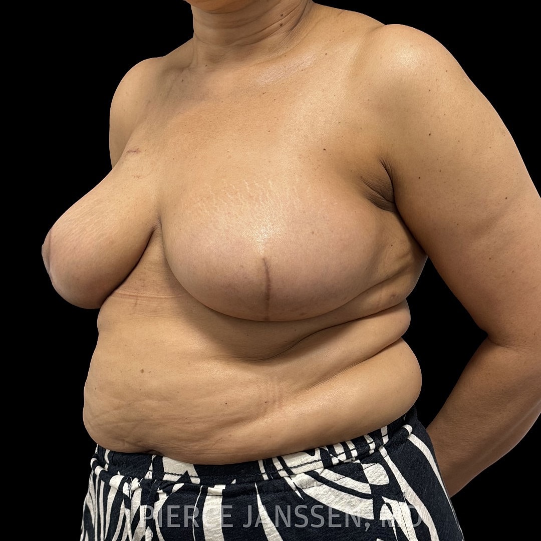 Breast Reconstruction (Implant-Based) Before & After