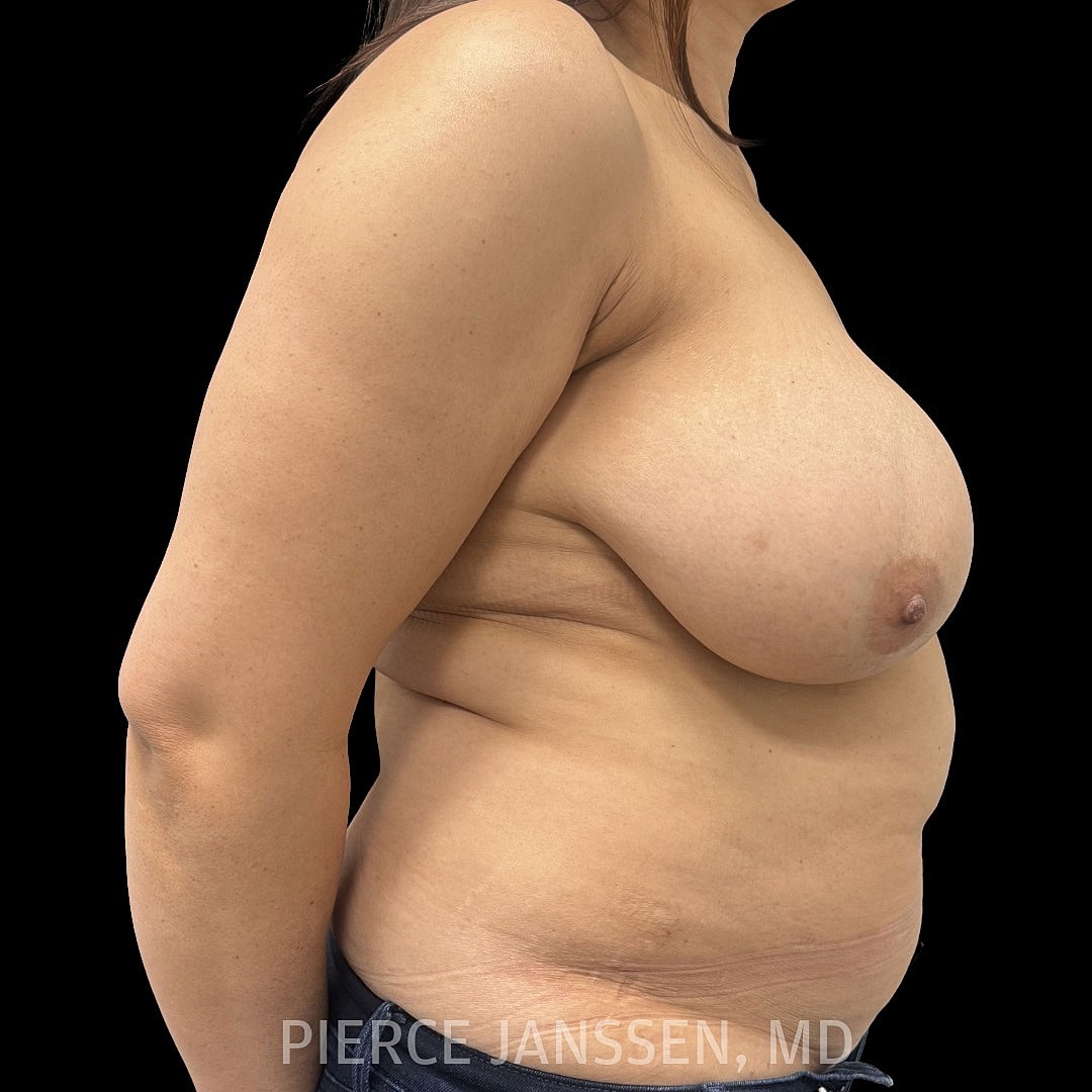 Breast Reconstruction (Implant-Based) Before & After