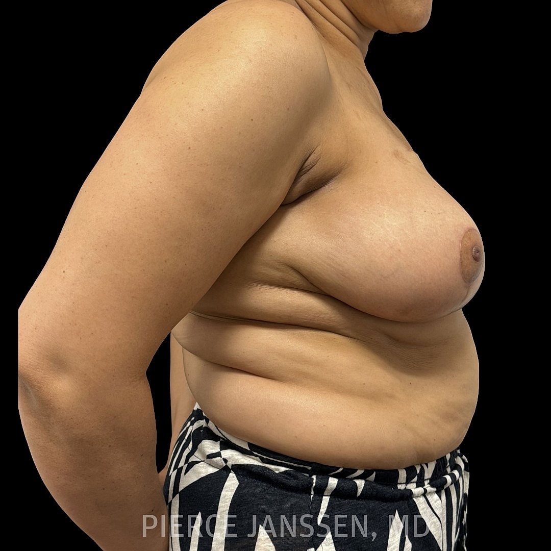 Breast Reconstruction (Implant-Based) Before & After